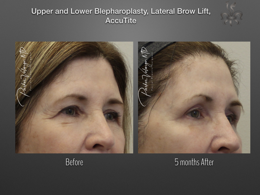 Brow Lift before and after