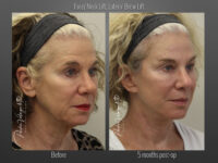 Brow Lift before and after