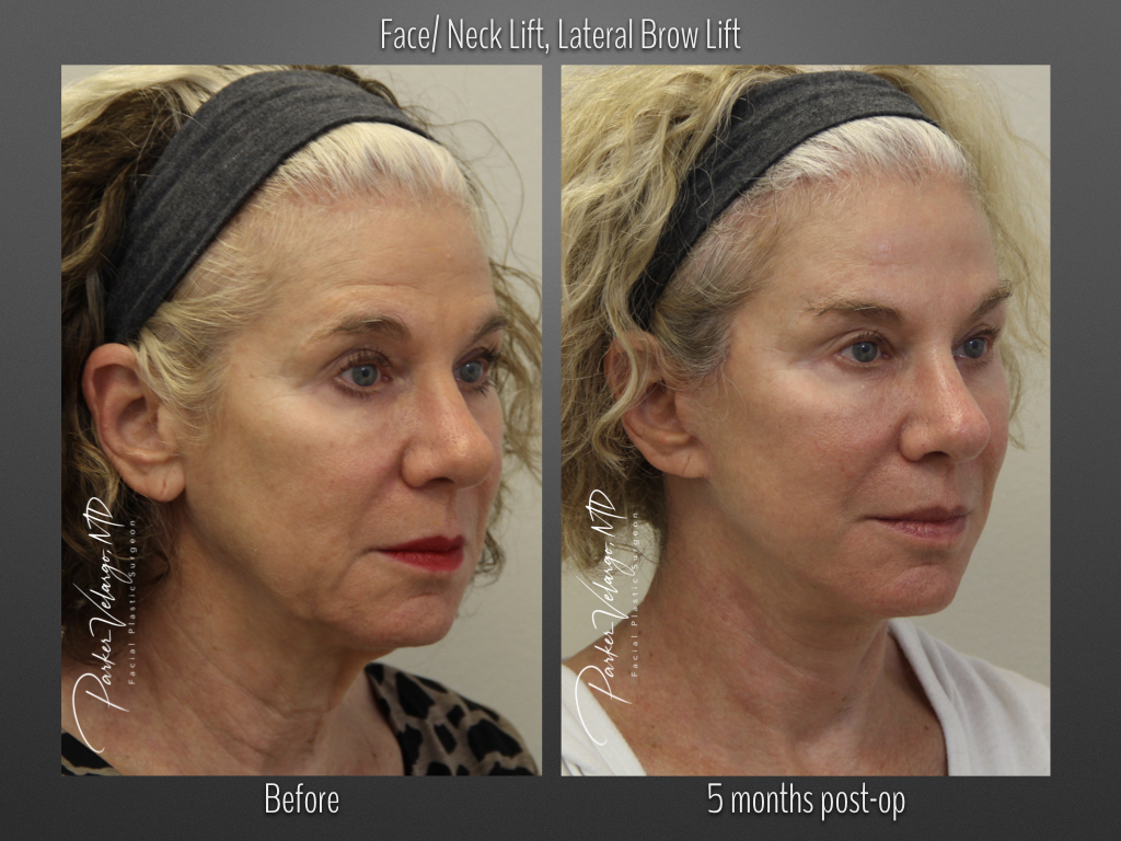 Brow Lift before and after