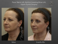 Brow Lift before and after