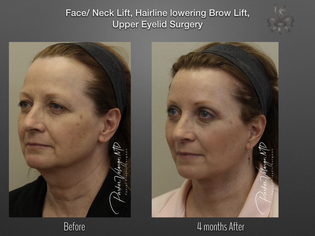 Brow Lift before and after