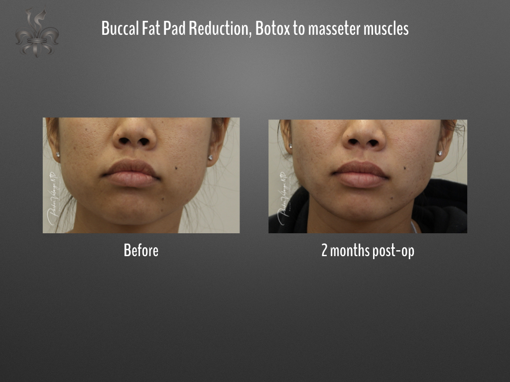 Buccal Fat Removal before and after