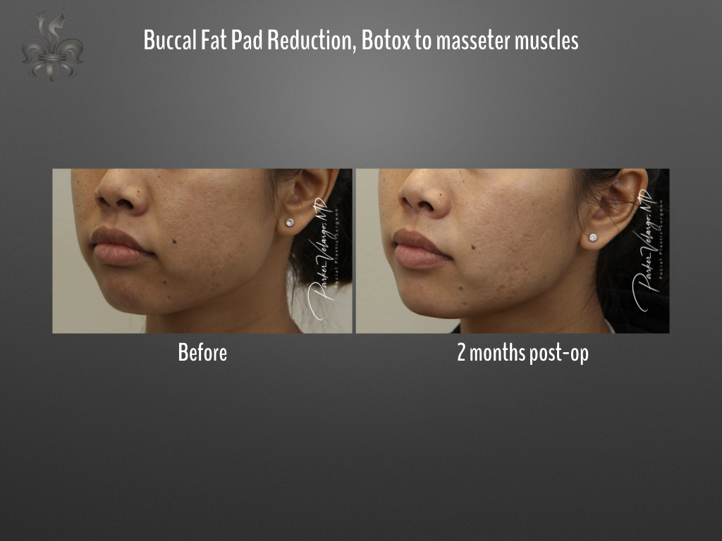 Buccal Fat Removal before and after