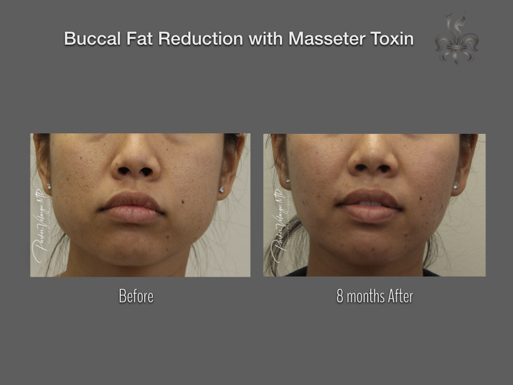 Buccal Fat Removal before and after
