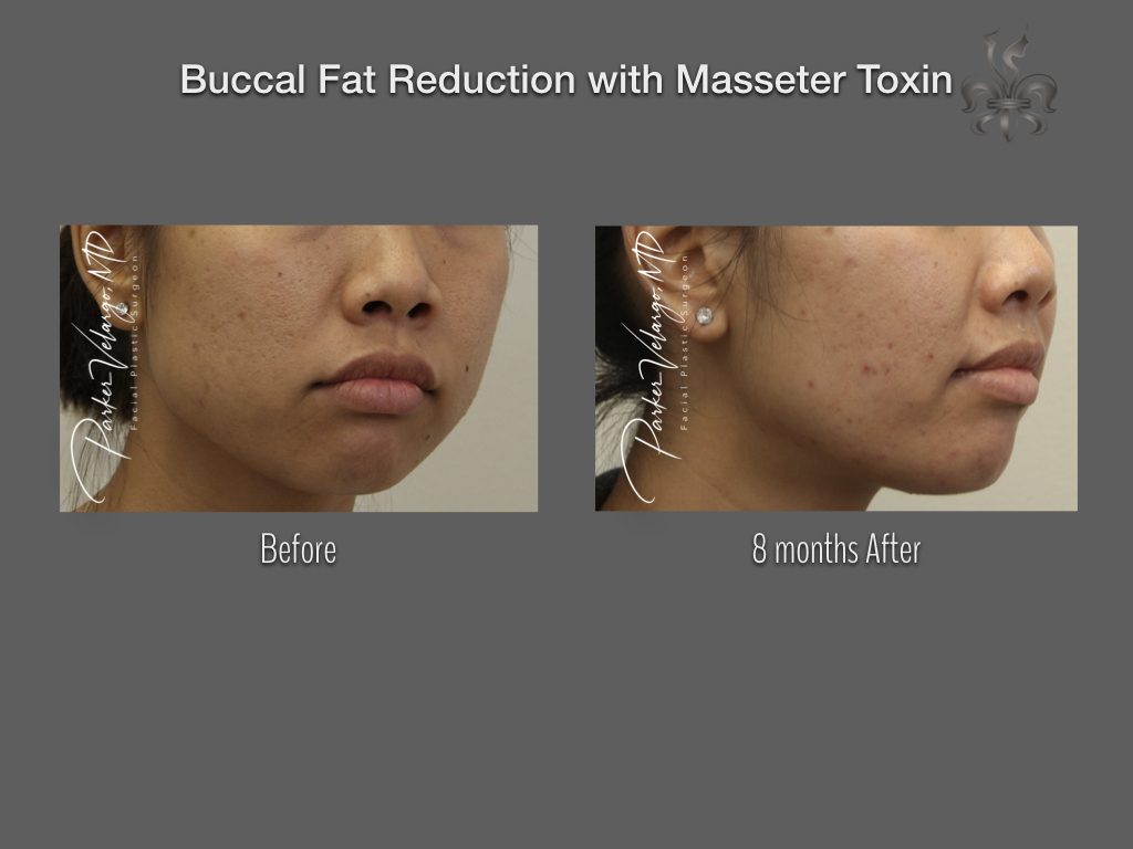 Buccal Fat Removal before and after