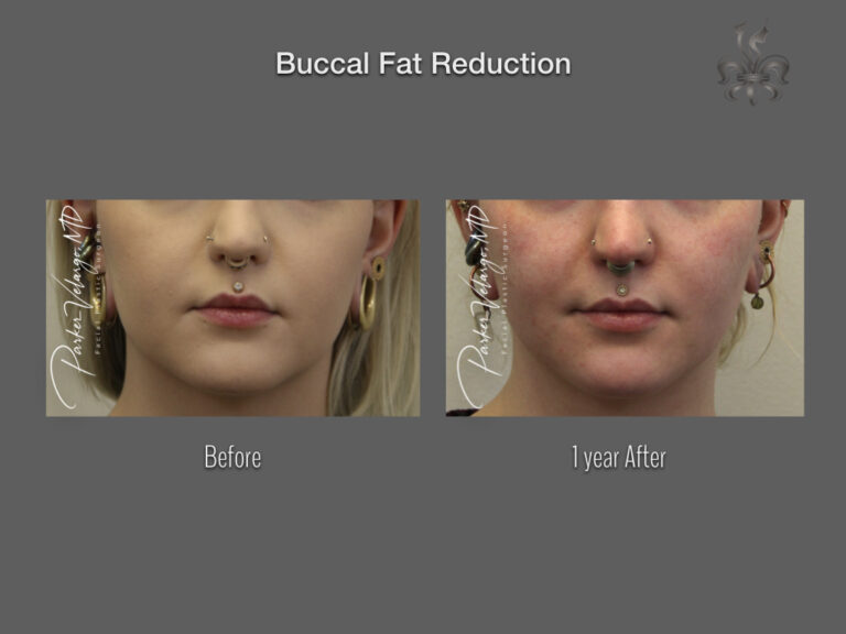 Buccal Fat Removal before and after