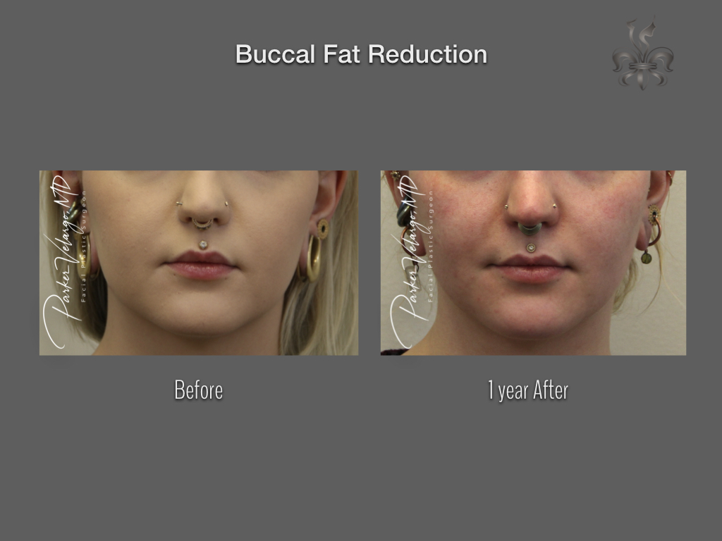 Buccal Fat Removal before and after