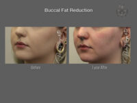 Buccal Fat Removal before and after