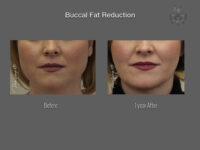 Buccal Fat Removal before and after