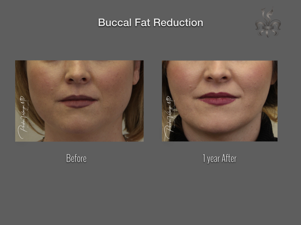 Buccal Fat Removal before and after