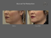 Buccal Fat Removal before and after