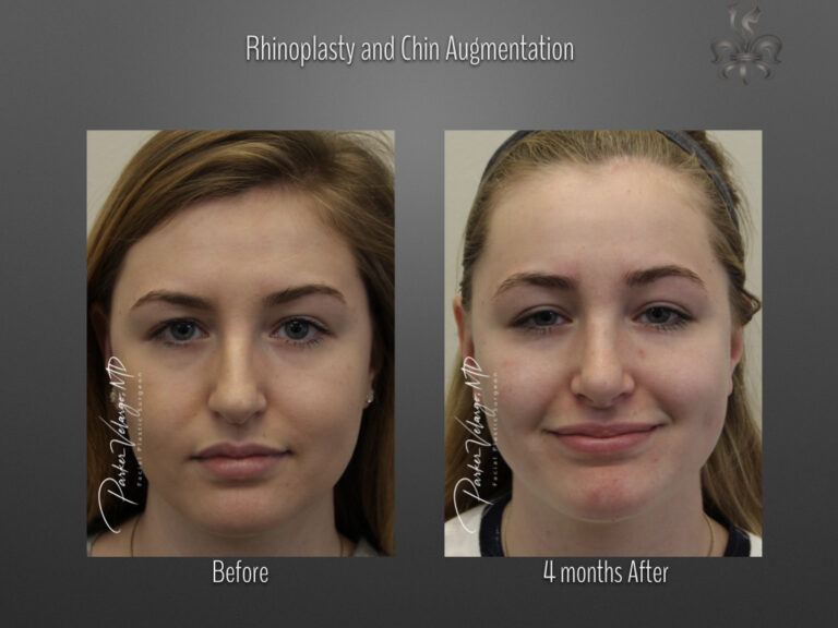 Chin Augmentation before and after