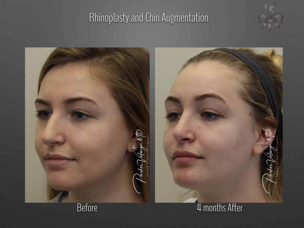 Chin Augmentation before and after