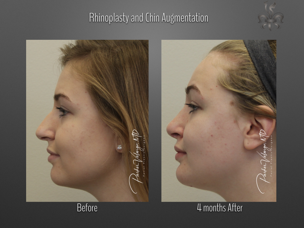 Chin Augmentation before and after