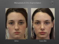 Chin Augmentation before and after
