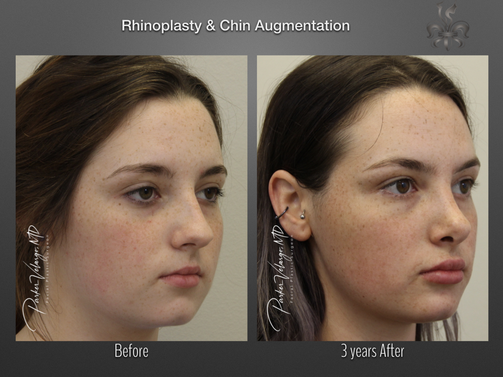 Chin Augmentation before and after