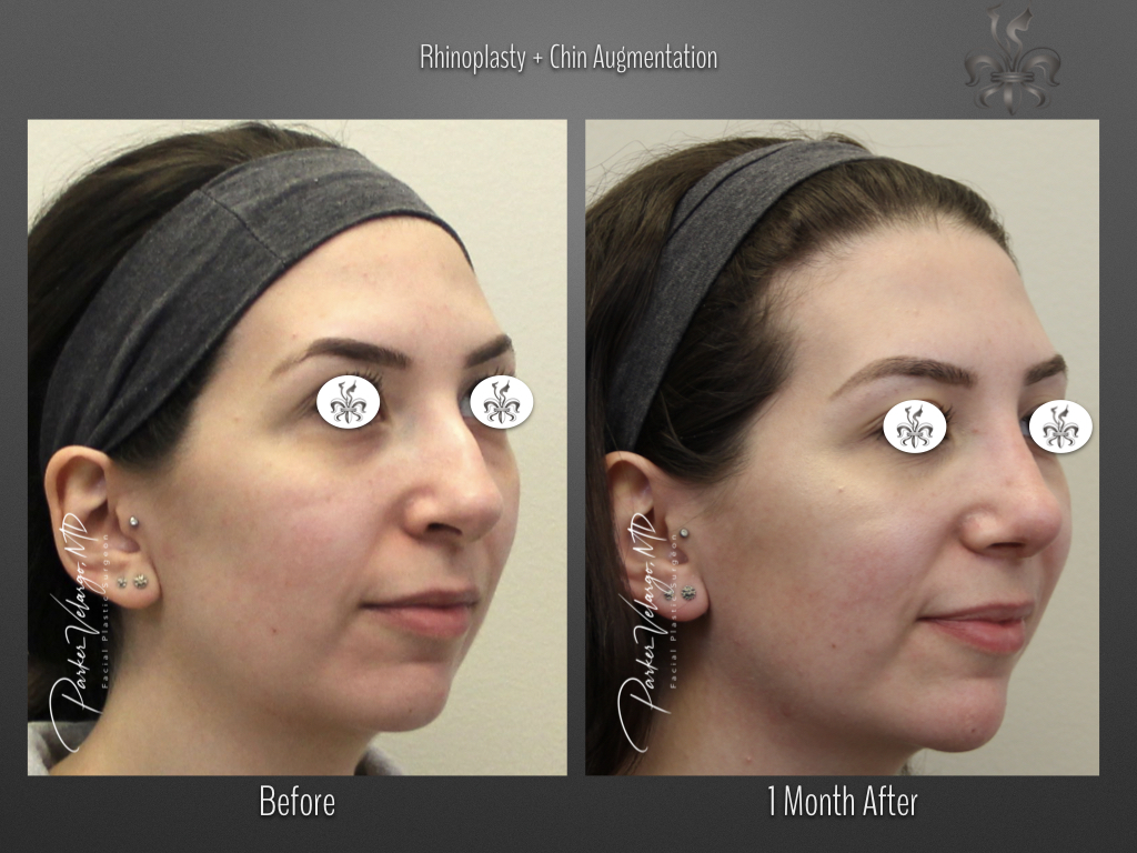 Chin Augmentation before and after