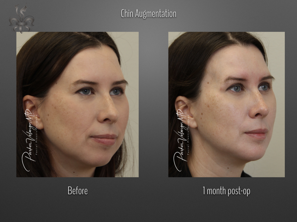 Chin Augmentation before and after