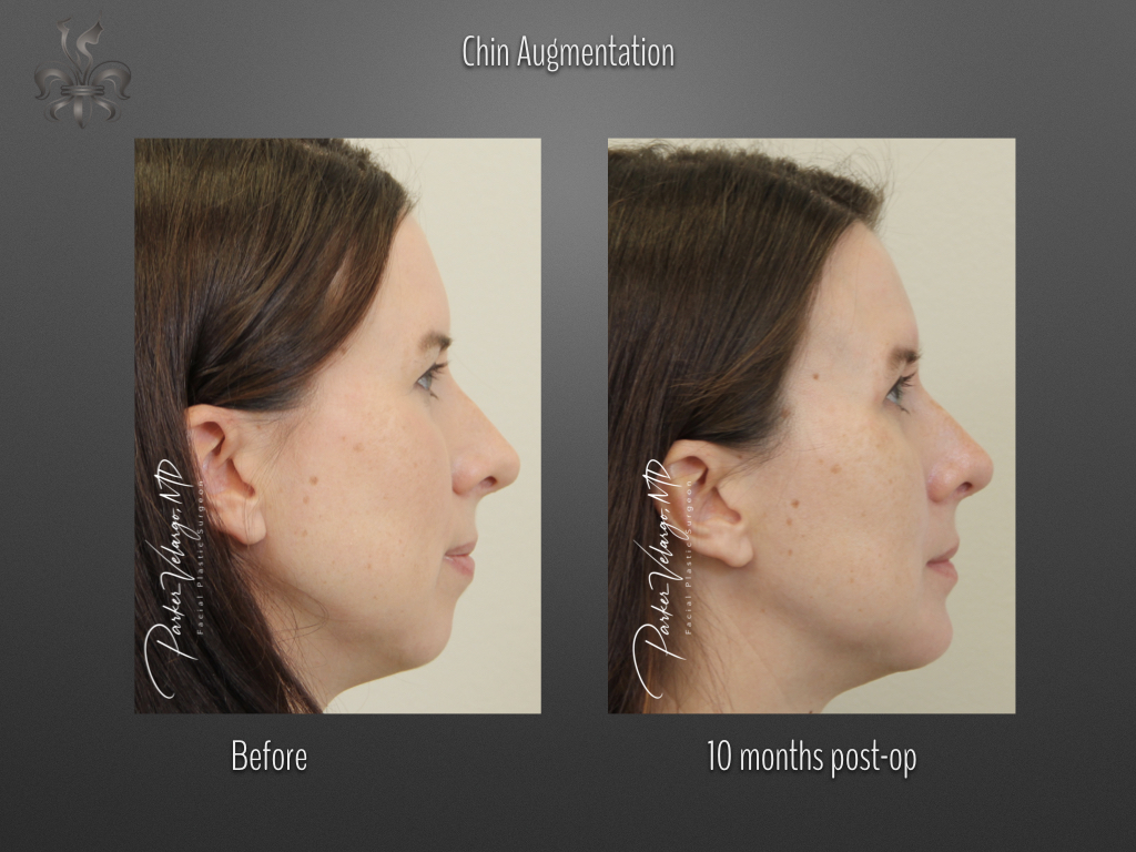 Chin Augmentation before and after