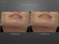 Chin Augmentation before and after