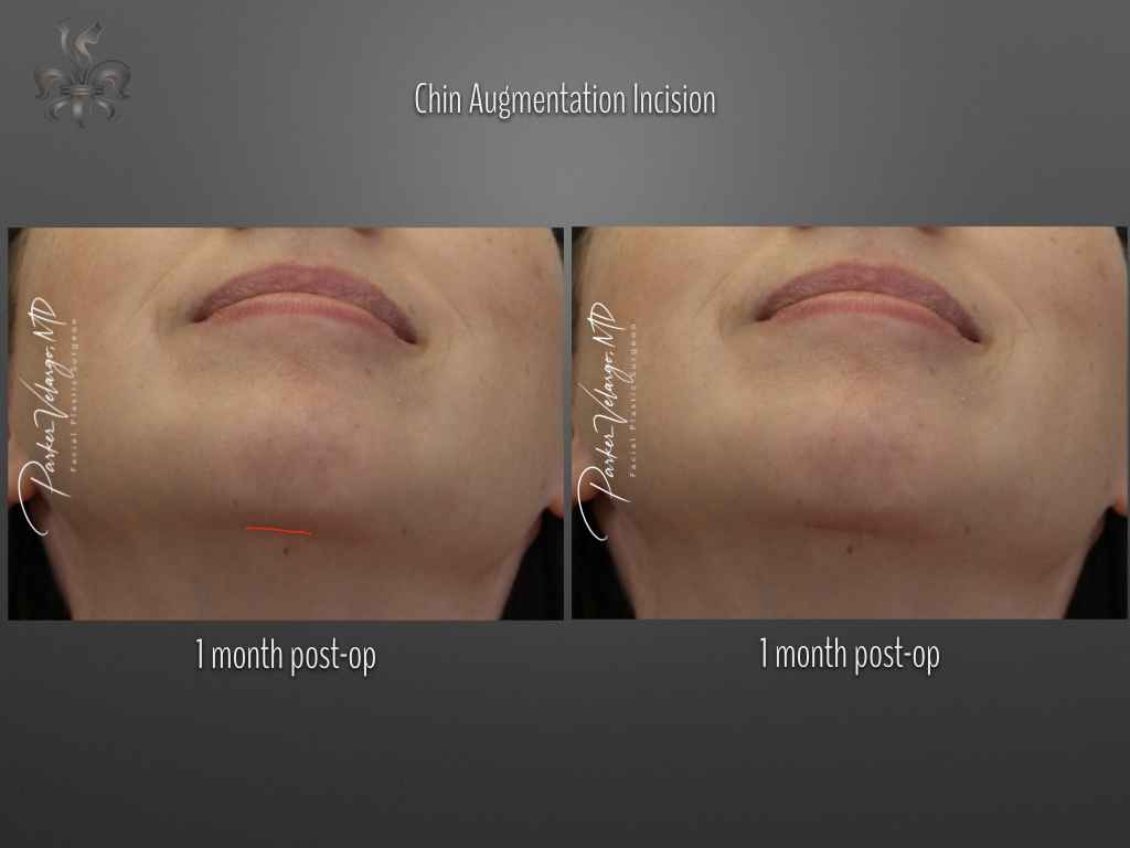 Chin Augmentation before and after