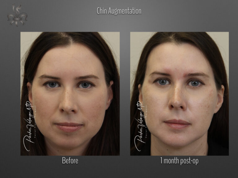 Chin Augmentation before and after