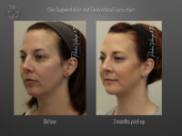 Chin Augmentation before and after