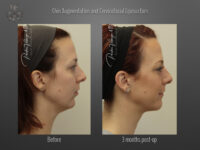 Chin Augmentation before and after