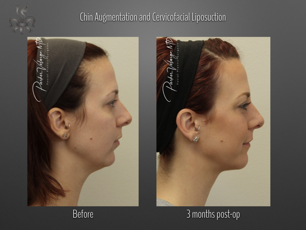 Chin Augmentation before and after