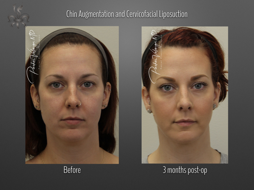 Chin Augmentation before and after