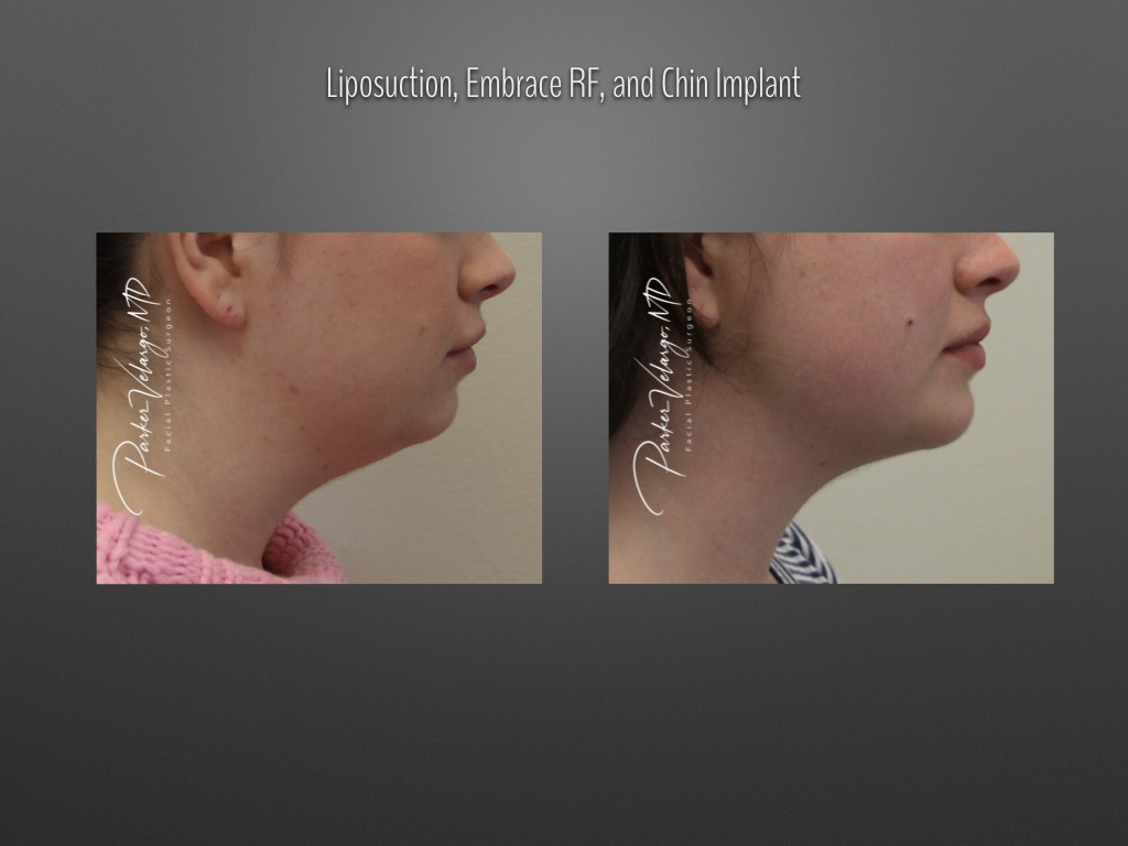 Chin augmentation before and after