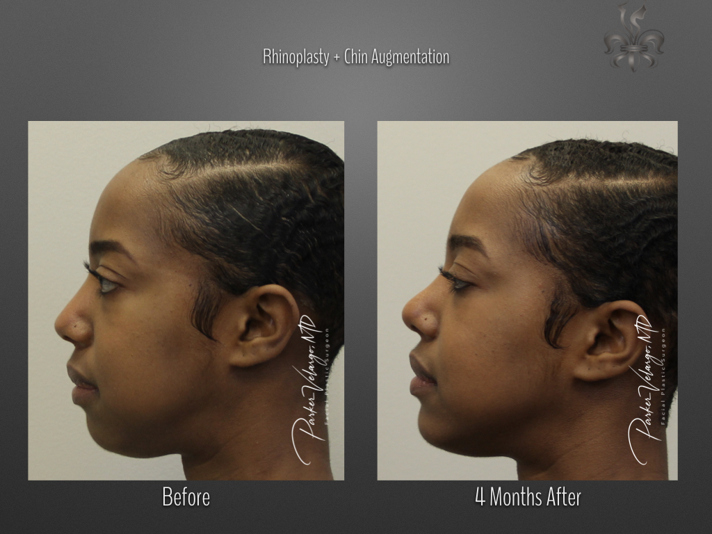 Chin augmentation before and after