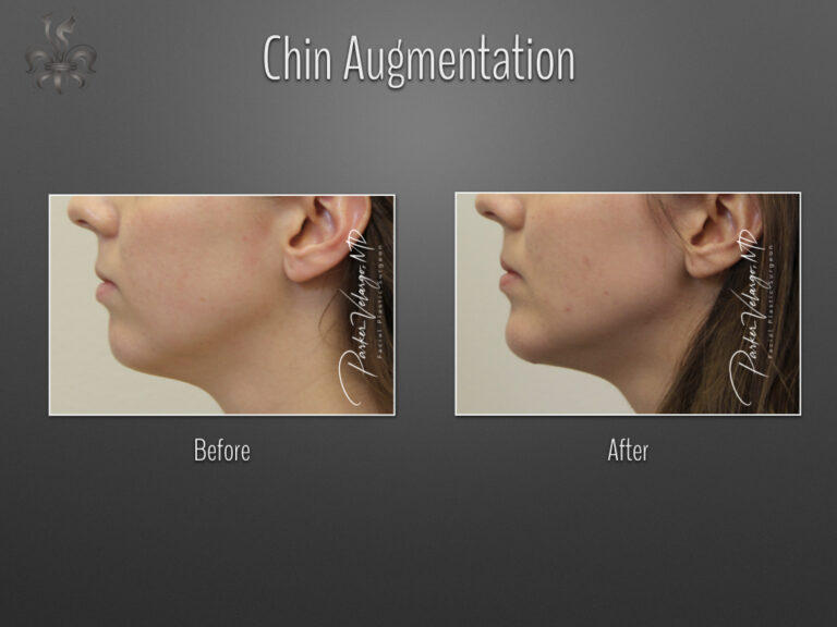 Chin augmentation before and after