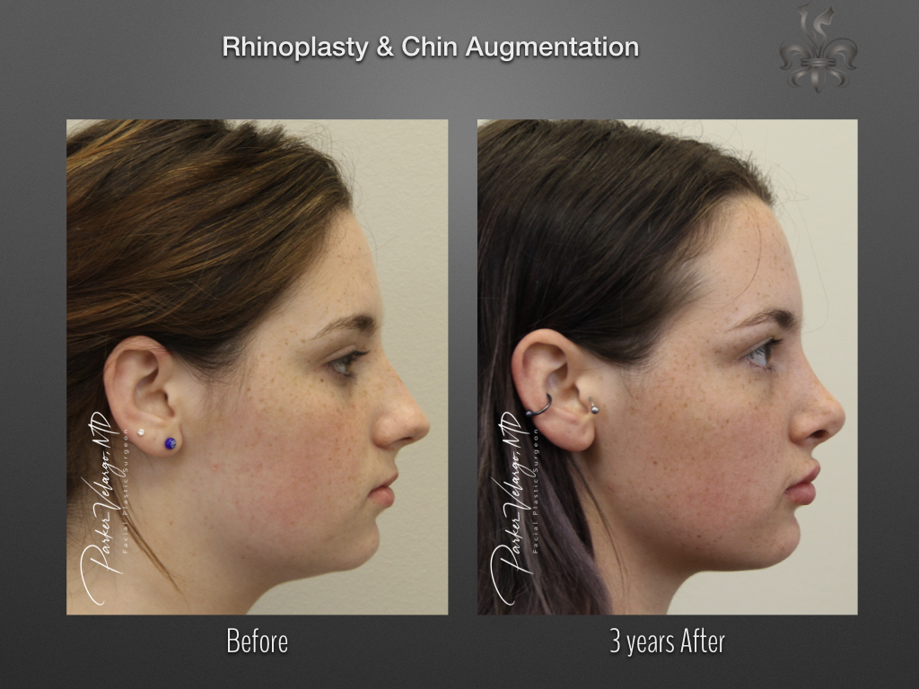 Chin augmentation before and after