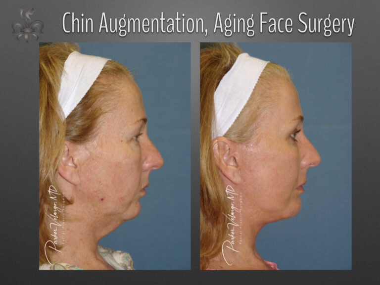Chin augmentation before and after