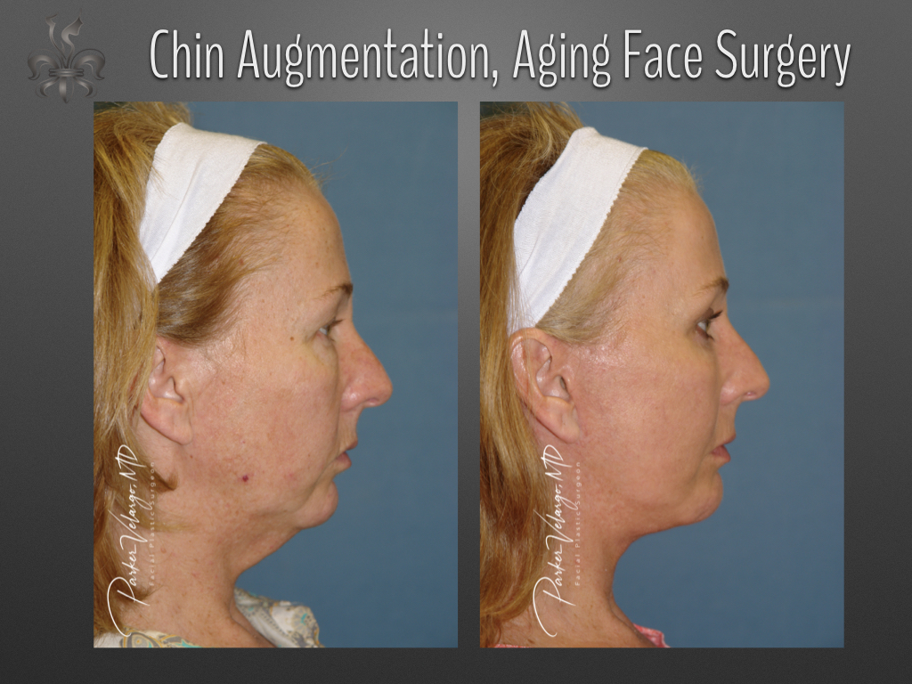 Chin augmentation before and after