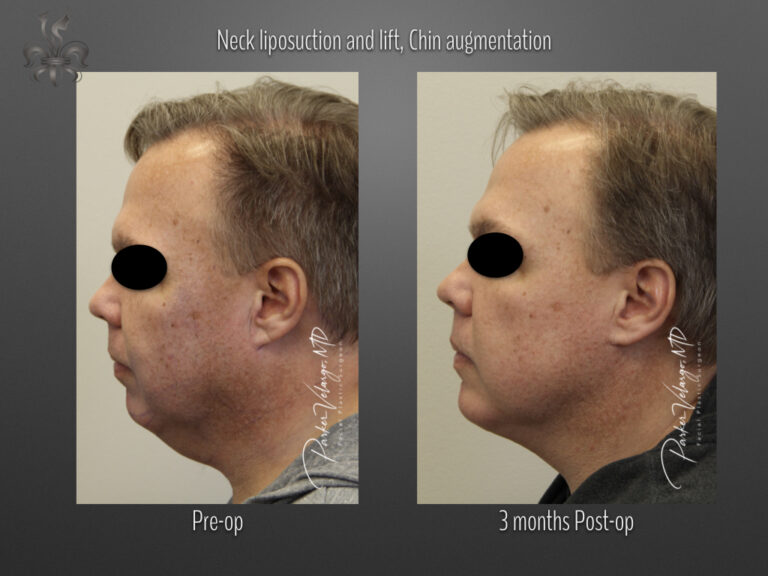Chin augmentation before and after