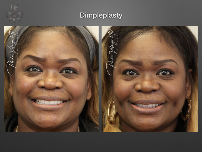 Dimpleplasty before and after