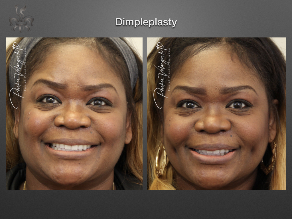 Dimpleplasty before and after