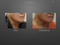 Direct Neck Lift before and after