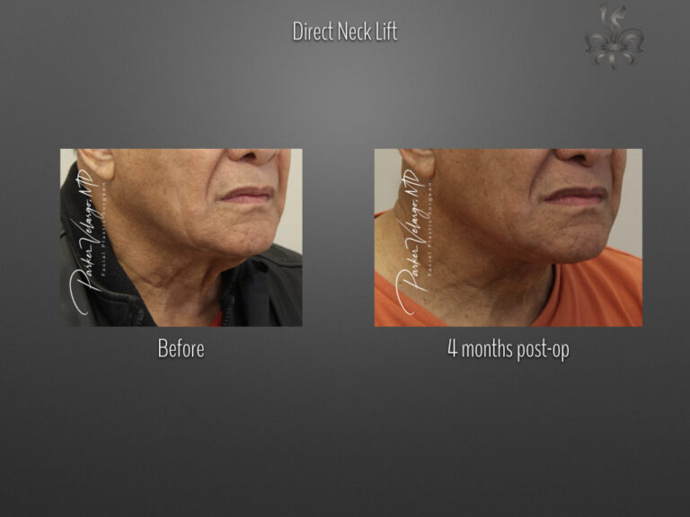 Direct Neck Lift before and after