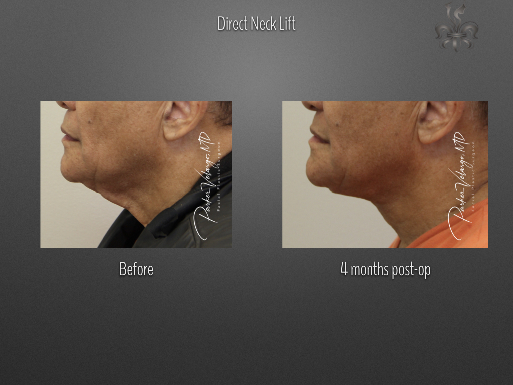 Direct Neck Lift before and after