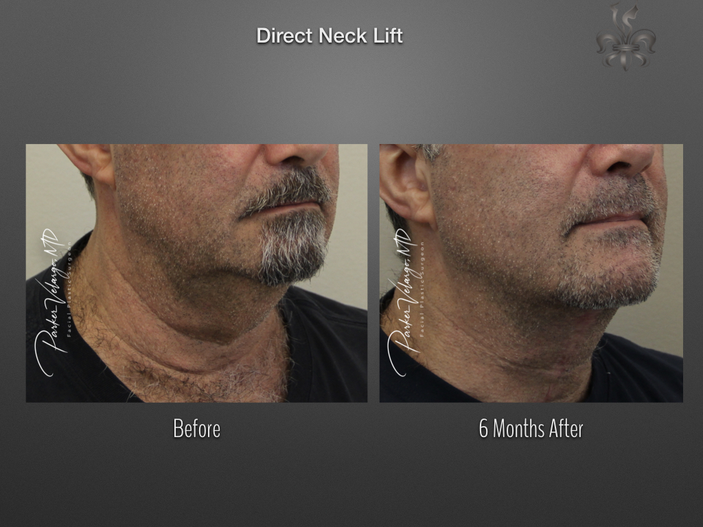 Direct Neck Lift before and after