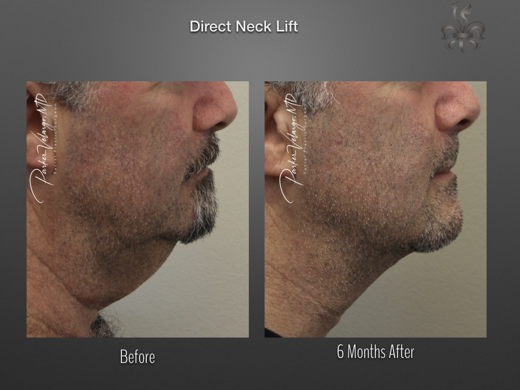 Direct Neck Lift before and after