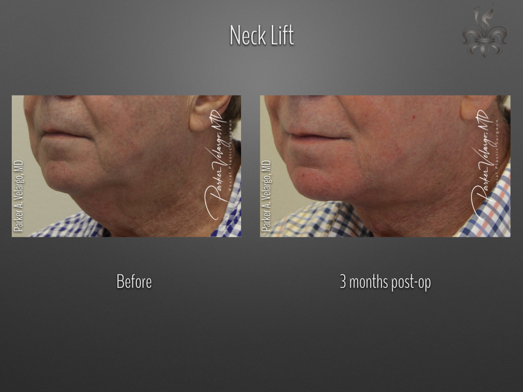 Face/Neck Lift before and after