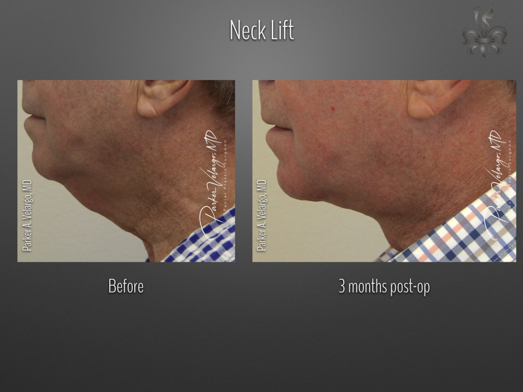 Face/Neck Lift before and after