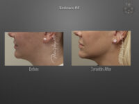 EmbraceRF before and after