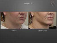 EmbraceRF before and after