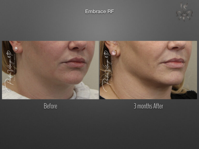 EmbraceRF before and after
