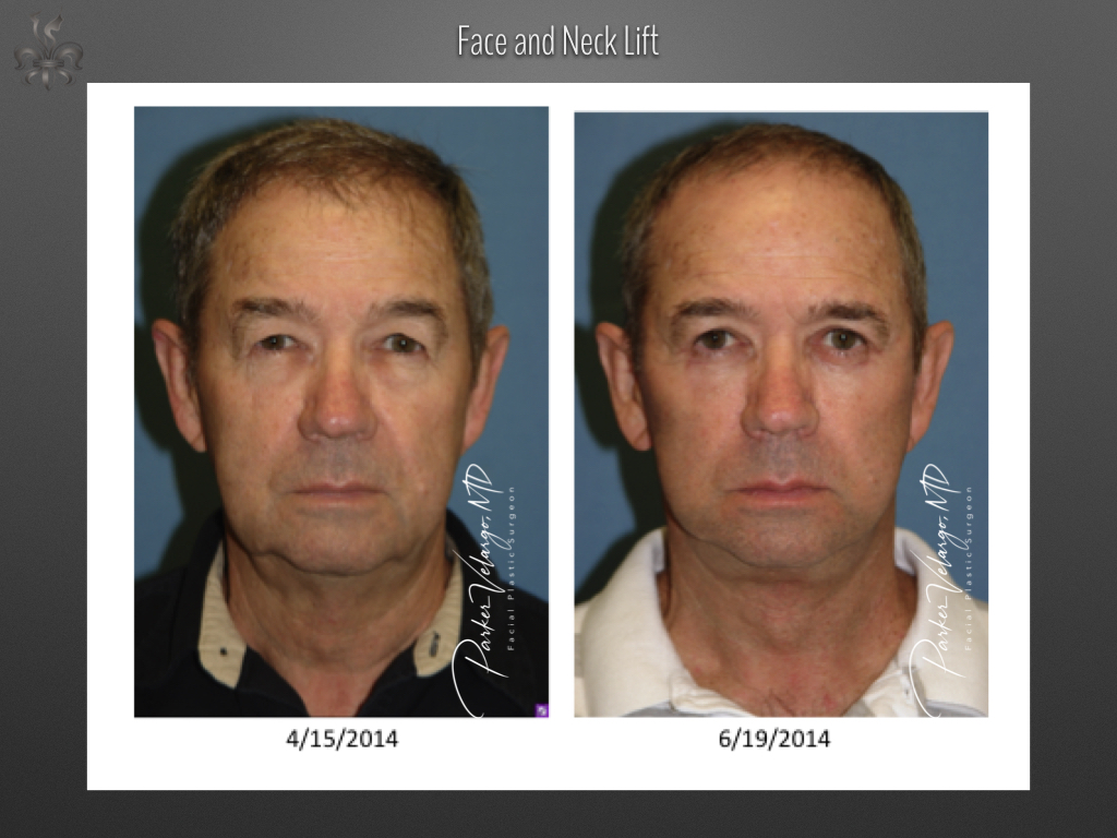 Face/Neck Lift before and after